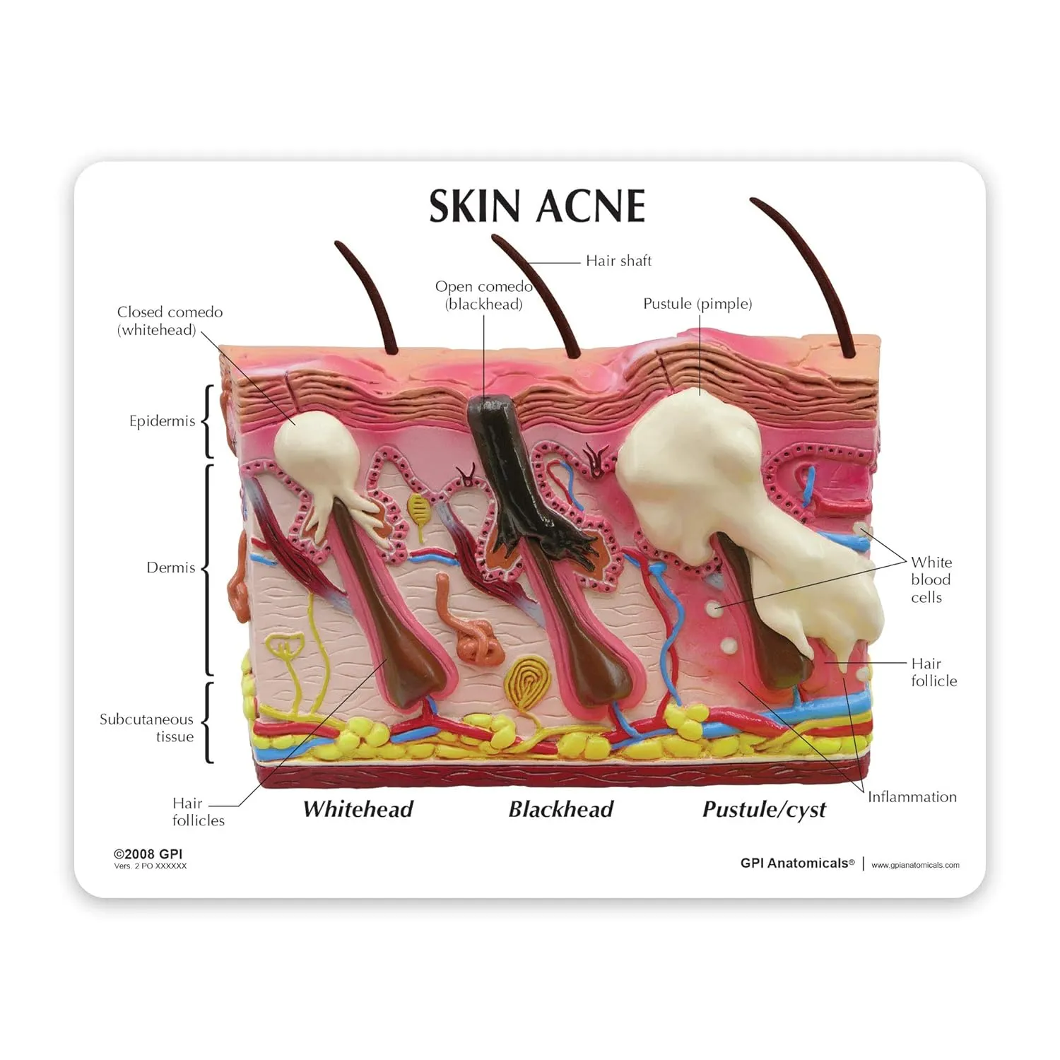 GPI Anatomicals - Skin Acne Model, Cross-Section Showing Normal and Common Acne-Riddled Skin for Human Anatomy, Physiology Education, Anatomy Model for Doctor's Office, Medical Learning Resources